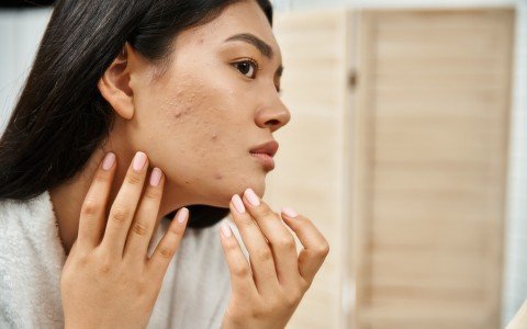 Rimedi naturali per l'acne e la pelle grassa: come curare la pelle dall'interno